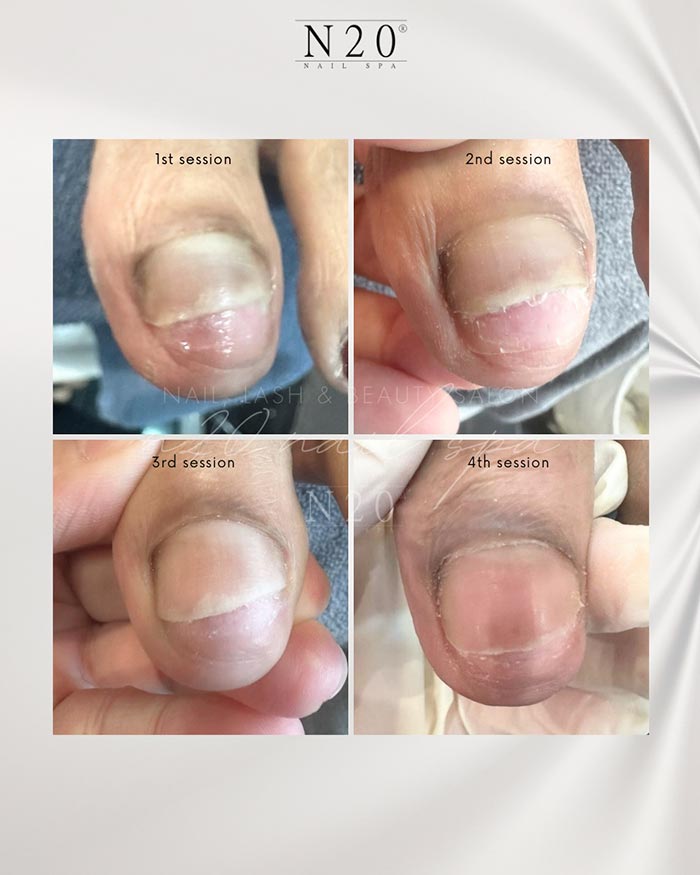 Toenail & fingernail renewal treatment