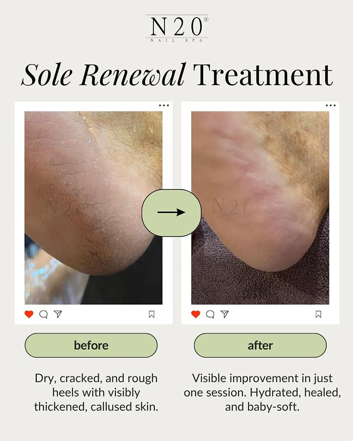 sole renewal treatment before after