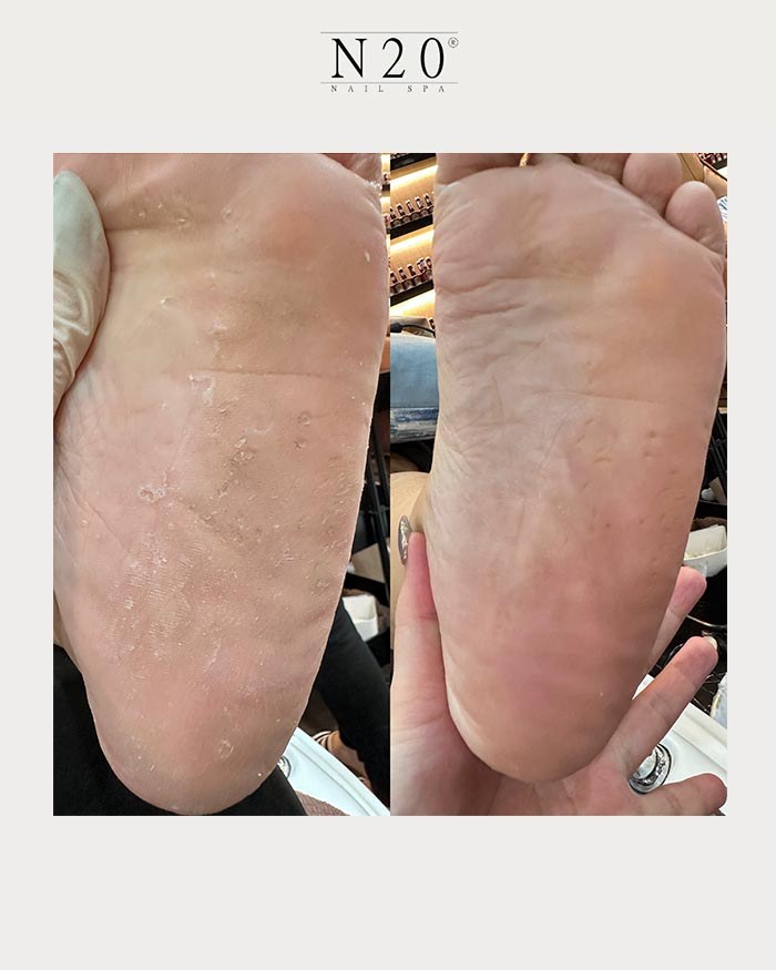 sole renewal treatment before after
