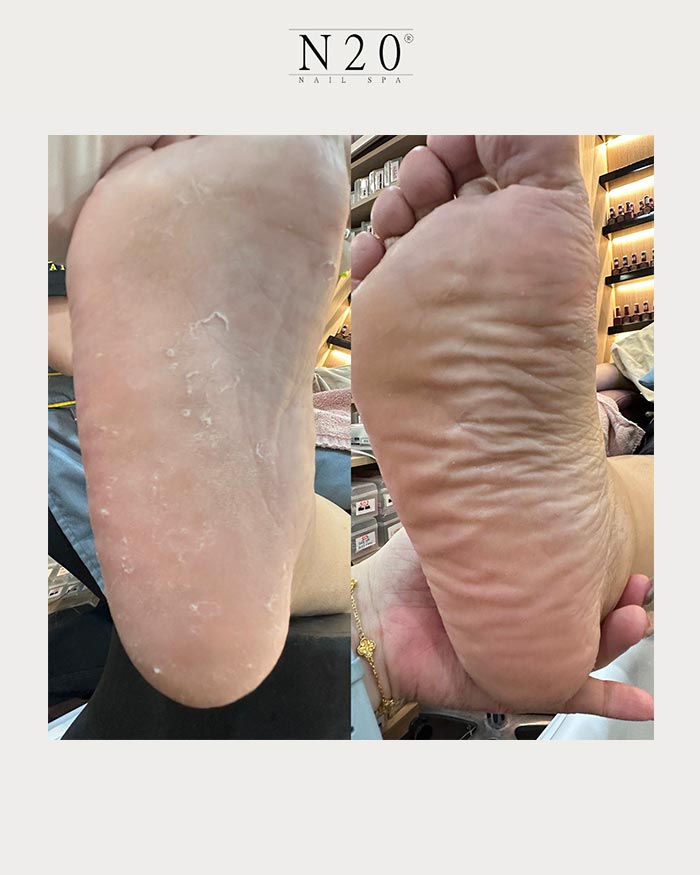 sole renewal treatment before after