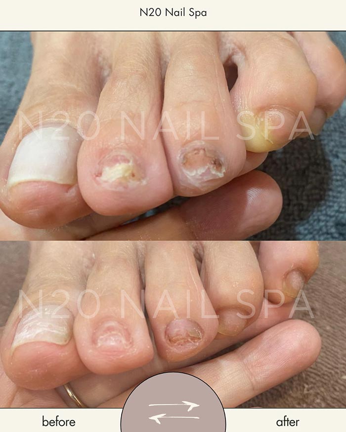 Results of PACT Light Treatment on toenails Results of PACT Light Treatment on toenails